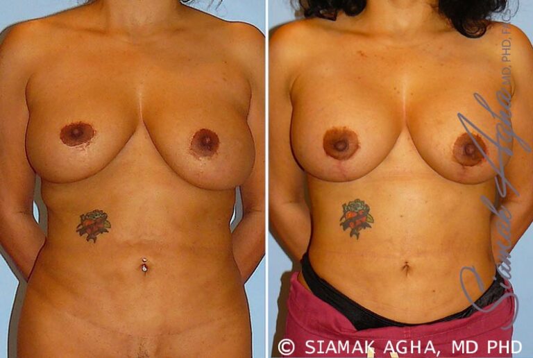 Breast Lift with Augmentation