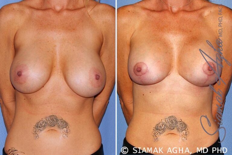 Breast Lift with Augmentation