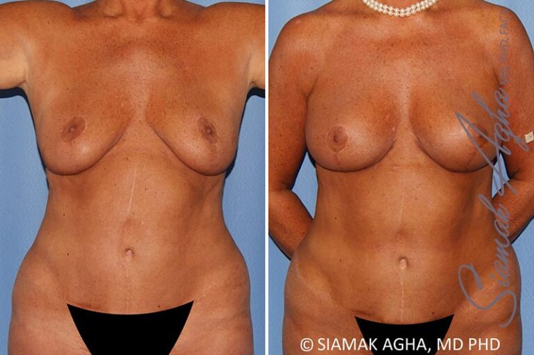 Breast Lift with Augmentation