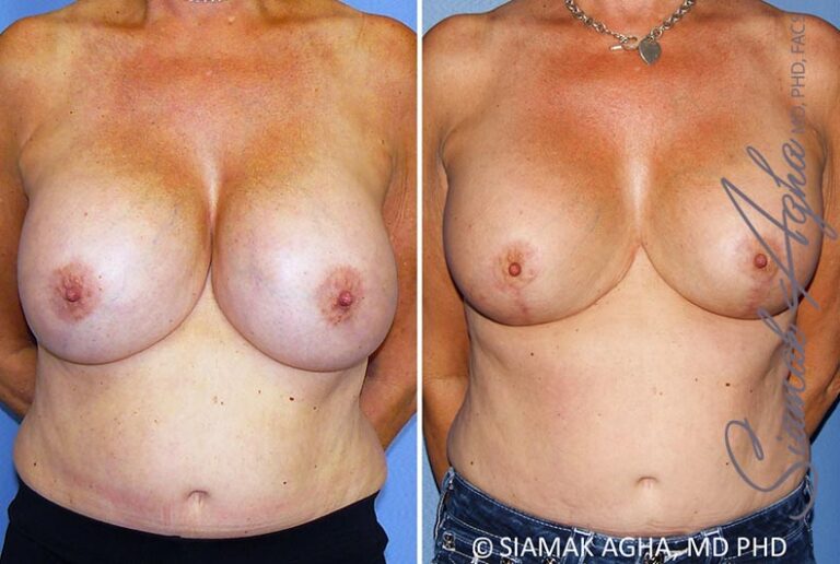 Breast Lift with Augmentation