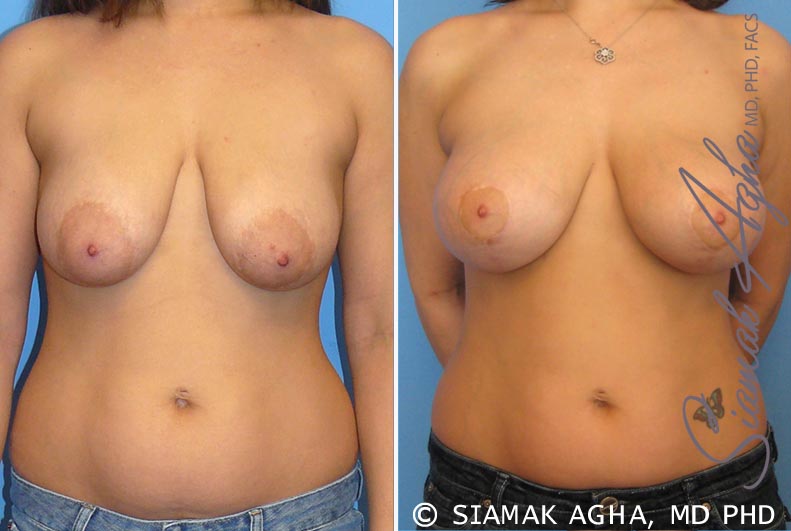 Breast Lift with Augmentation