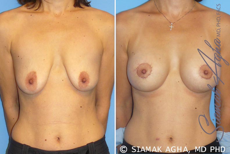 Breast Lift with Augmentation