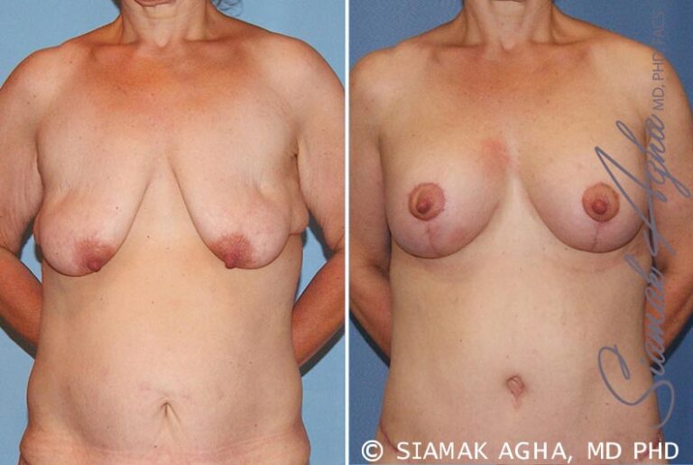 Breast Lift with Augmentation