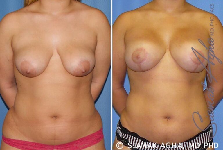 Breast Lift with Augmentation