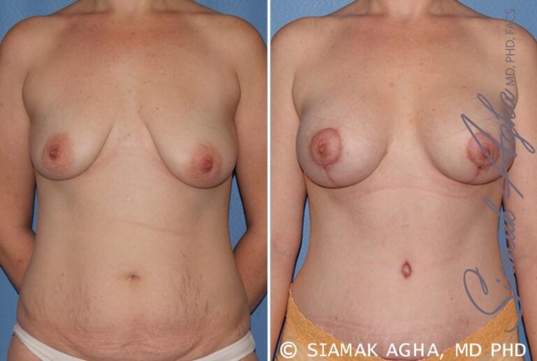 Breast Lift with Augmentation