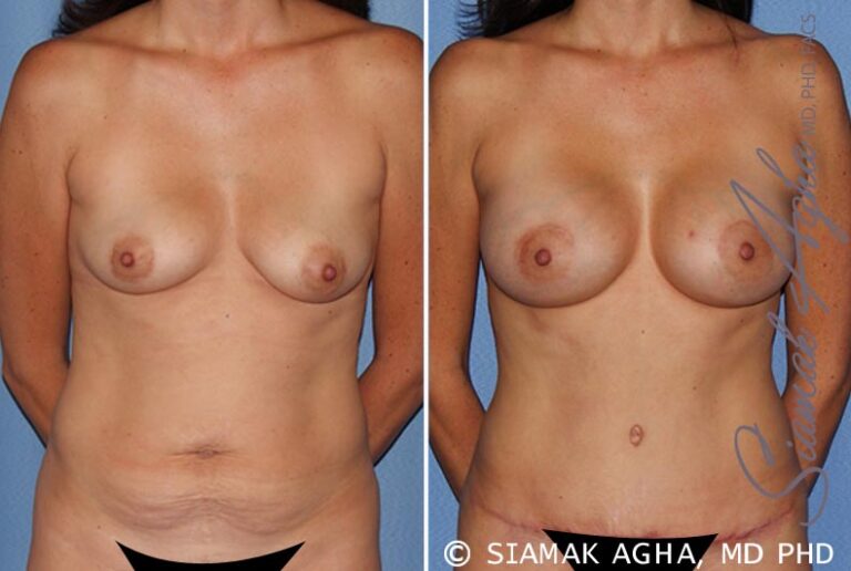 Breast Lift with Augmentation