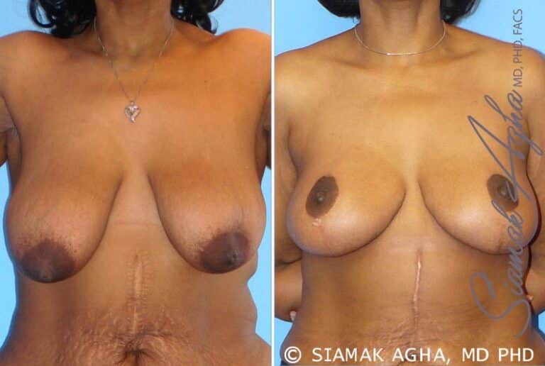 Breast Lift