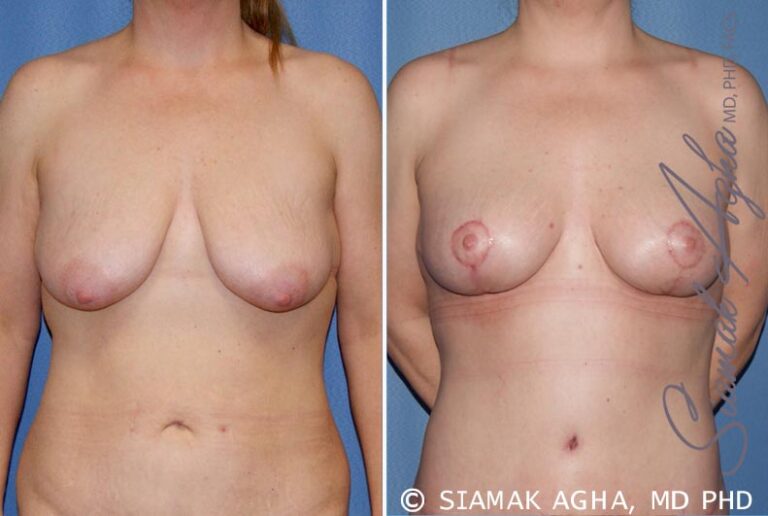 Breast Lift