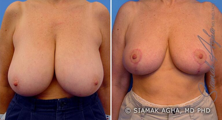 Breast Reduction