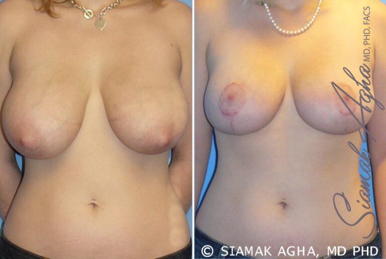 Breast Reduction