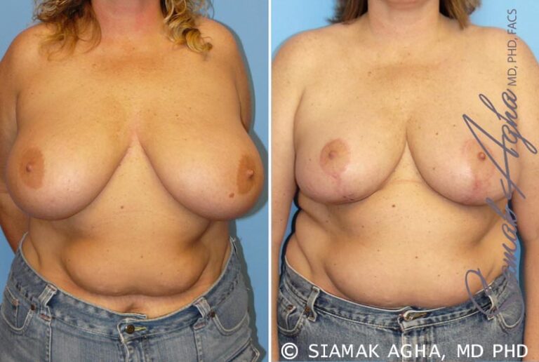 Breast Reduction