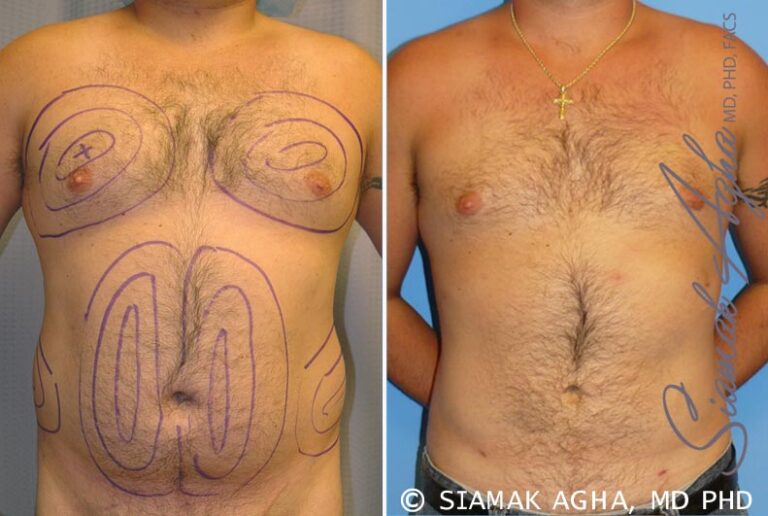 Male Breast Reduction