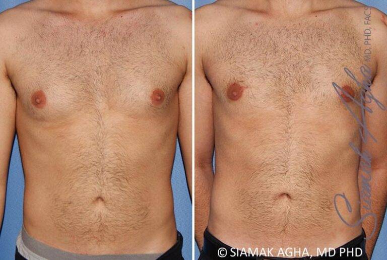 Male Breast Reduction