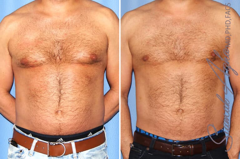 Male Breast Reduction