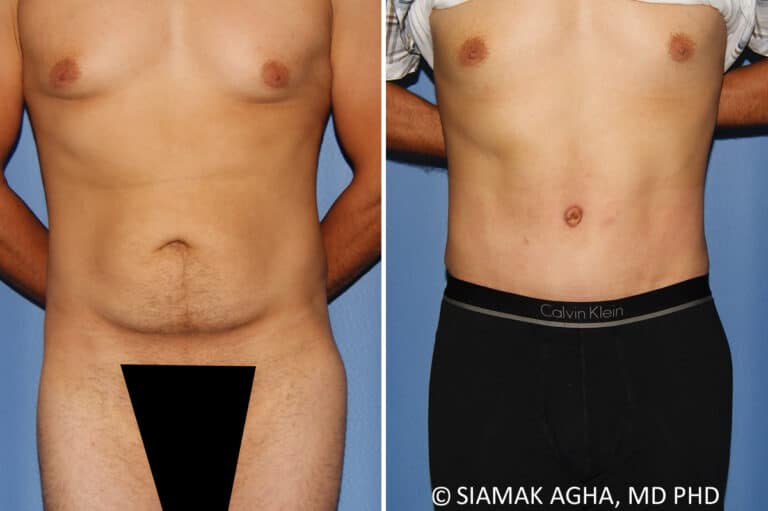 Male Breast Reduction