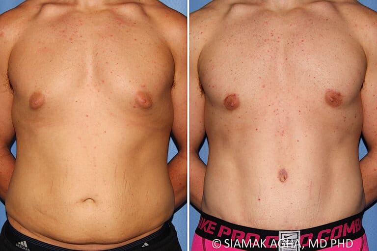 Male Breast Reduction