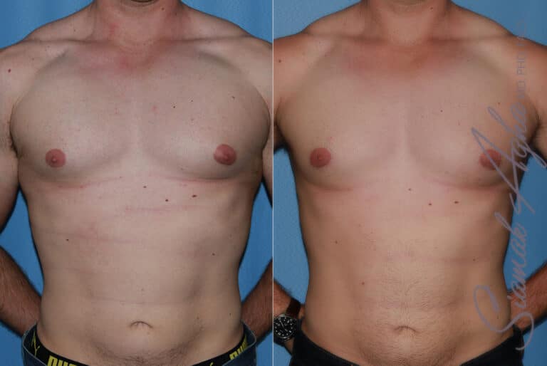 Male Breast Reduction