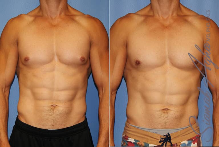 Male Breast Reduction