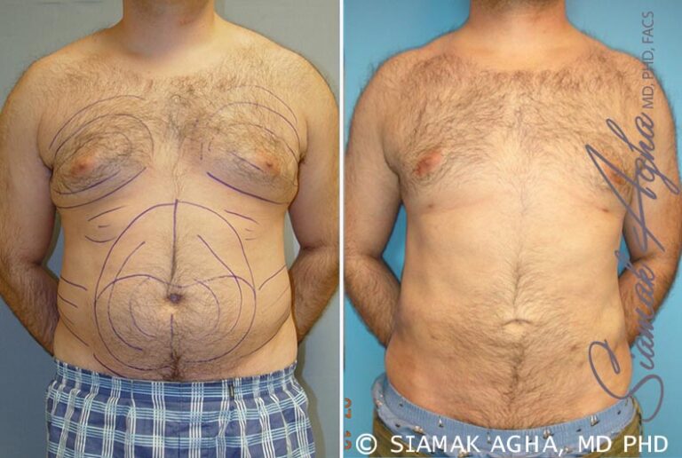 Male Breast Reduction