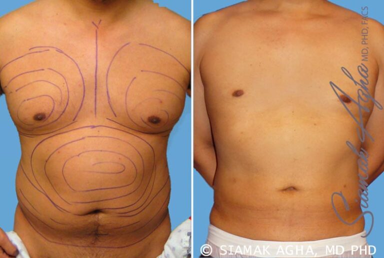 Male Breast Reduction