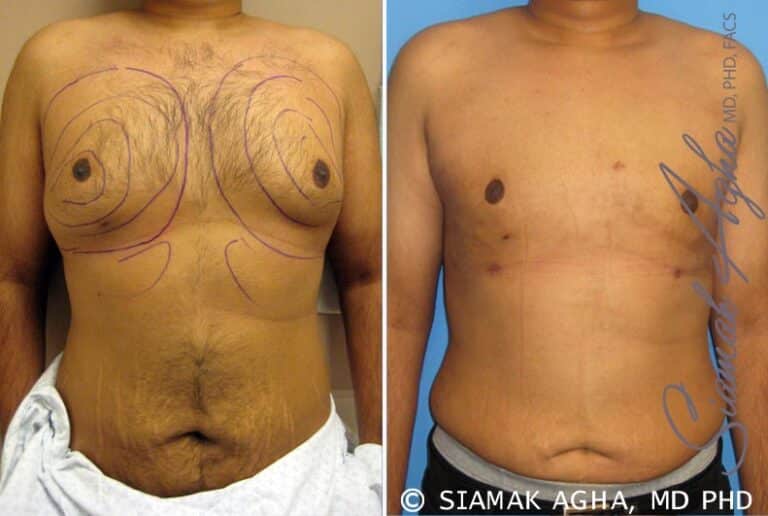 Male Breast Reduction