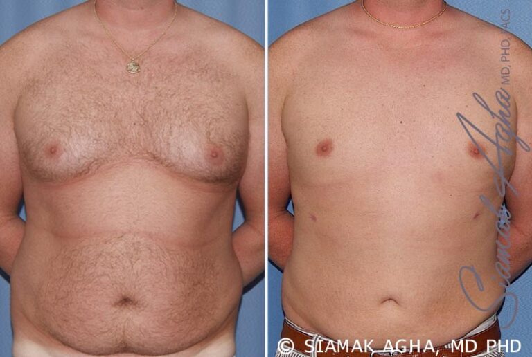 Male Breast Reduction