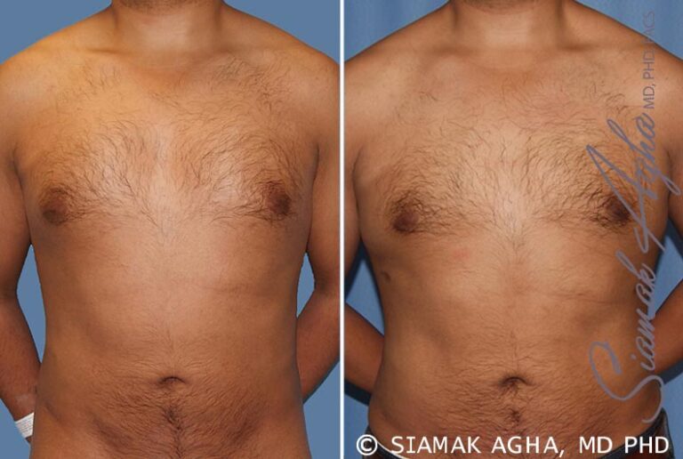 Male Breast Reduction