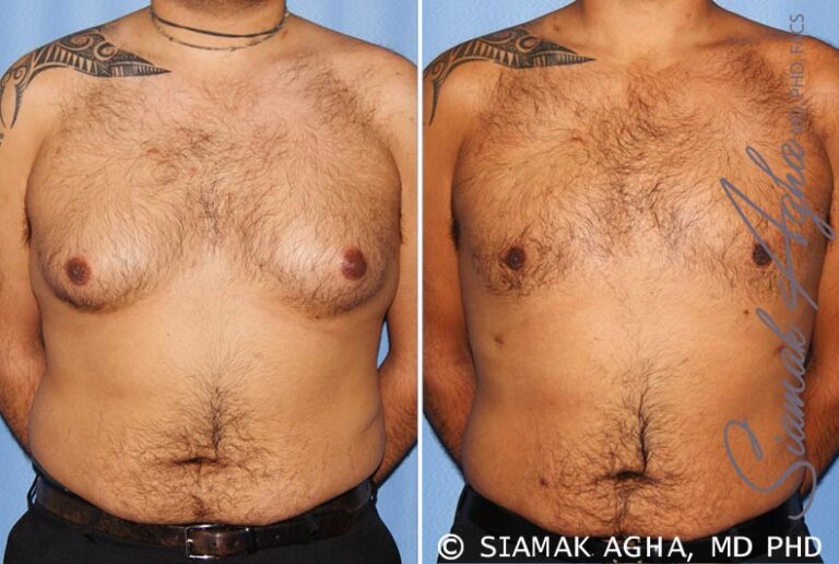 Male Breast Reduction