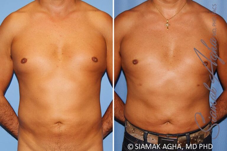 Male Breast Reduction