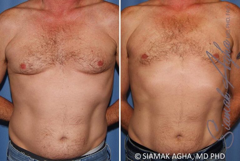 Male Breast Reduction