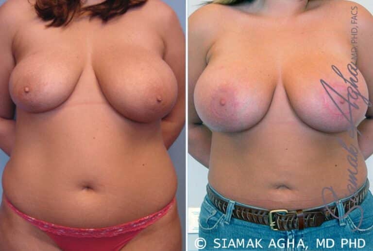 Breast Asymmetry