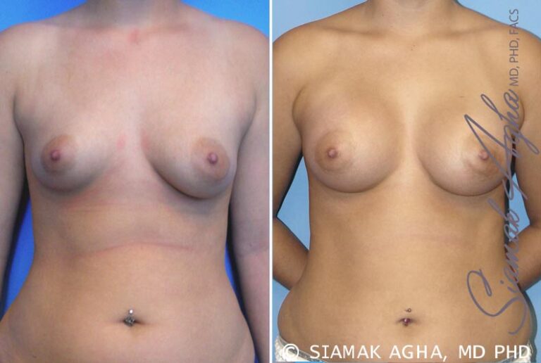 Breast Asymmetry