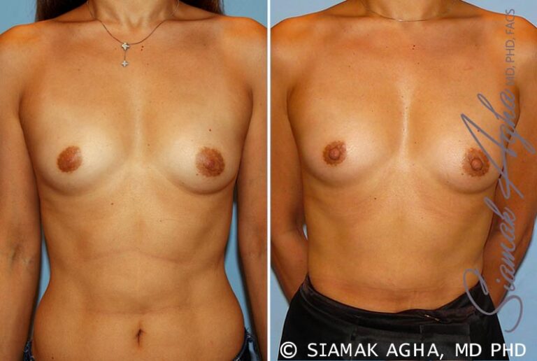 Breast Asymmetry