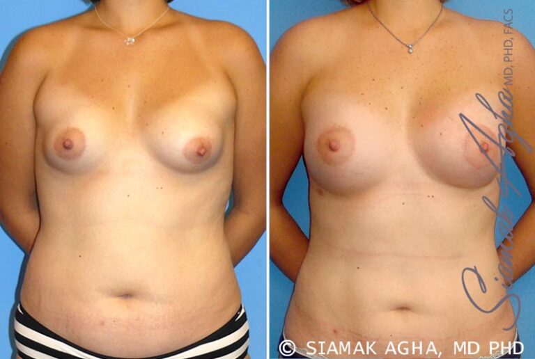 Breast Asymmetry