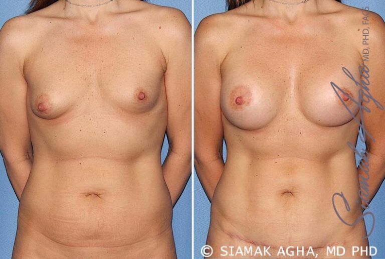 Breast Asymmetry