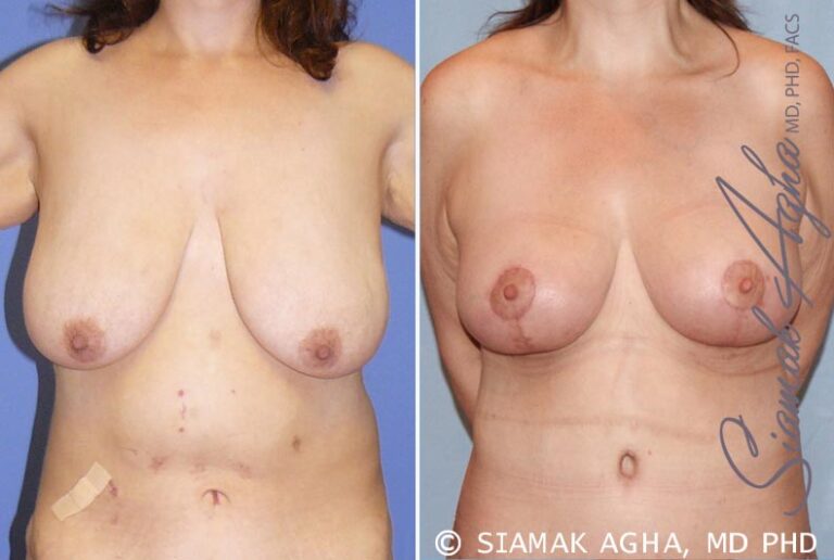 Breast Lift