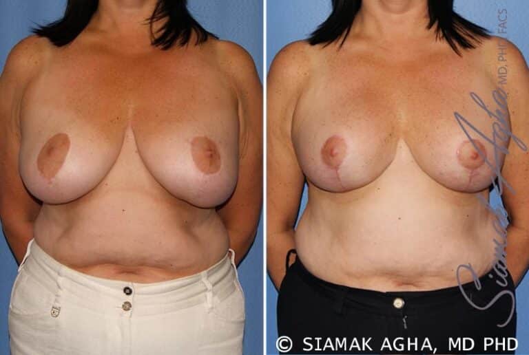 Breast Lift