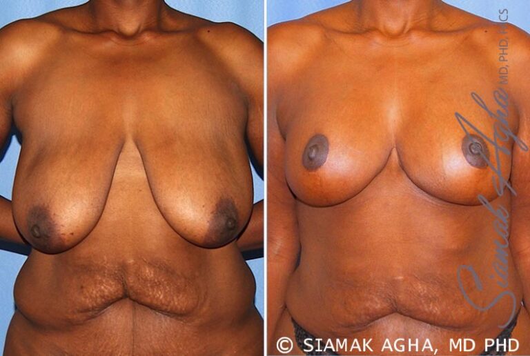 Breast Lift