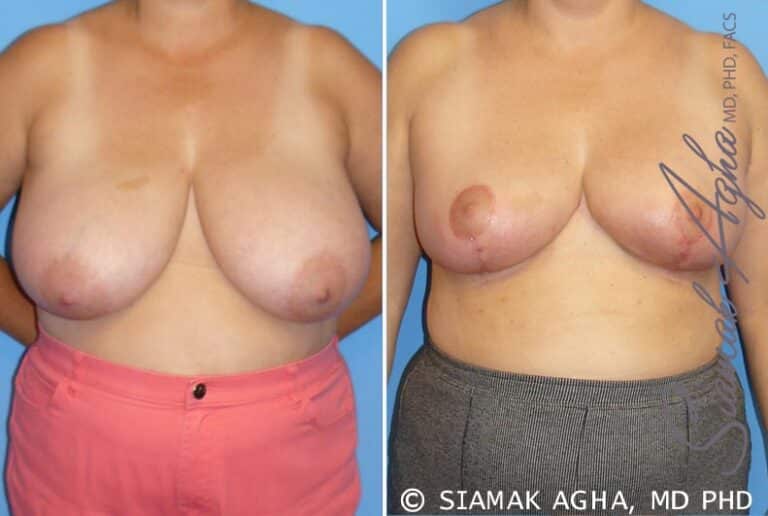 Breast Reduction