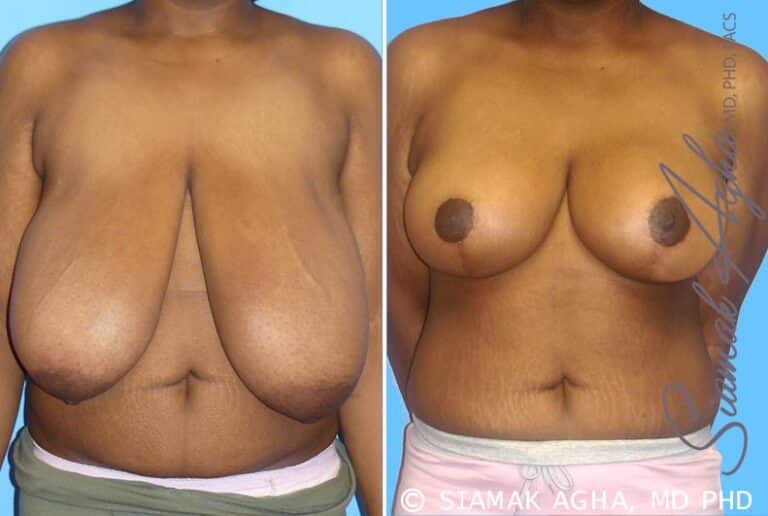 Breast Reduction