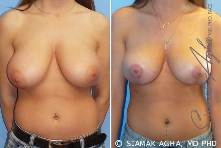 Breast Reduction