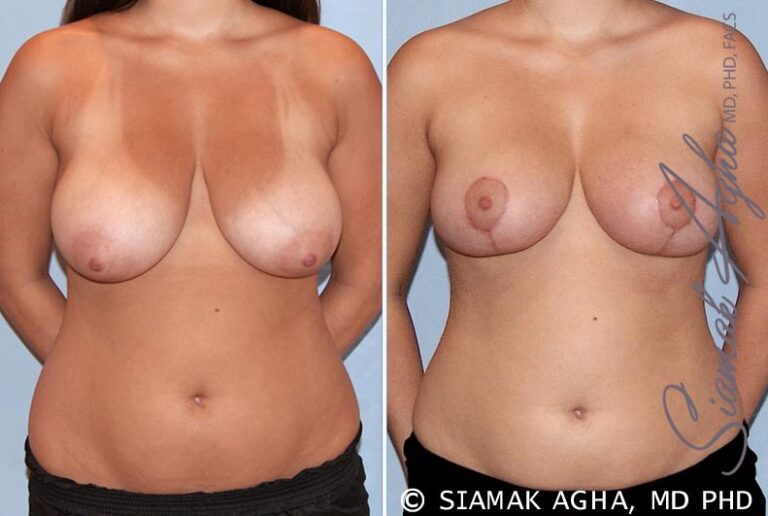 Breast Reduction