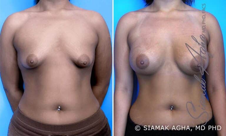 Tubular Breast Correction