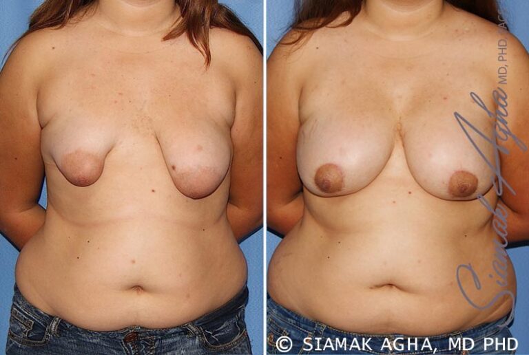 Tubular Breast Correction