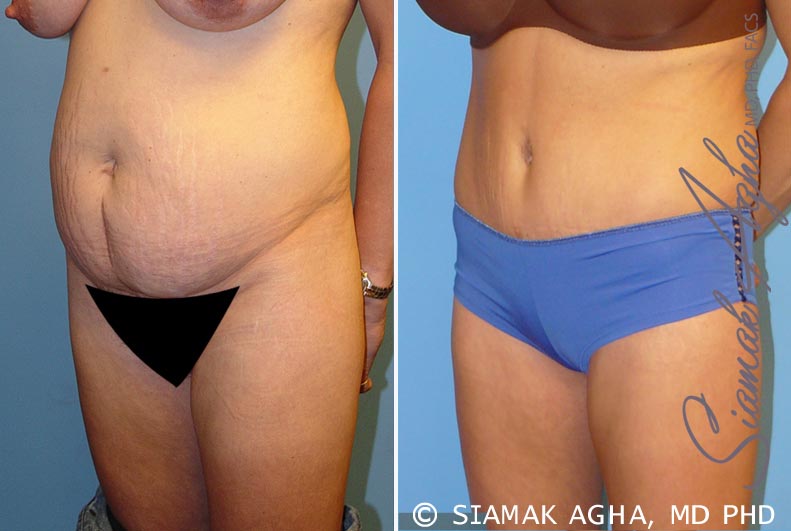 Tummy Tuck