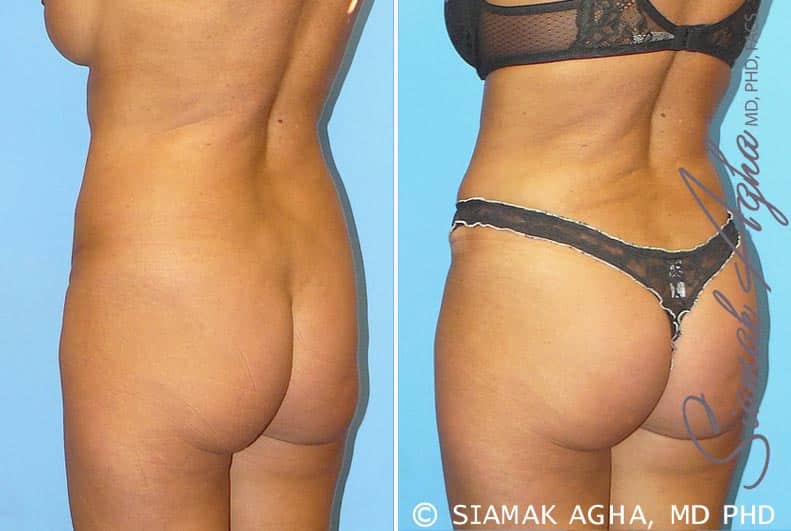 orange county brazilian butt lift patient 1 back left Newport Beach, CA