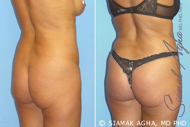 orange county brazilian butt lift patient 1 back right Newport Beach, CA