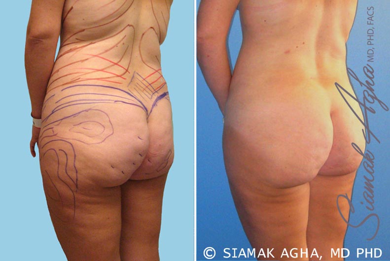 orange county brazilian butt lift patient 10 back left Newport Beach, CA