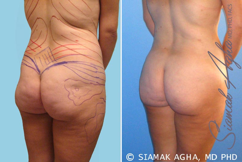 orange county brazilian butt lift patient 10 back right Newport Beach, CA