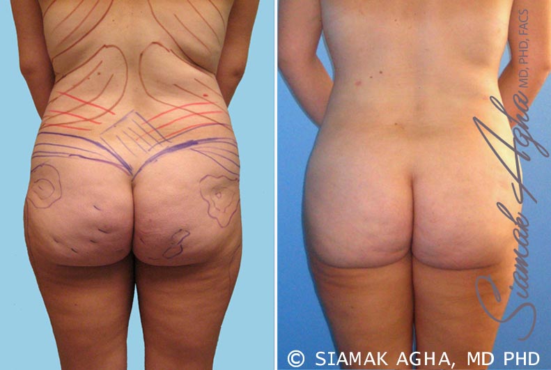 orange county brazilian butt lift patient 10 back Newport Beach, CA